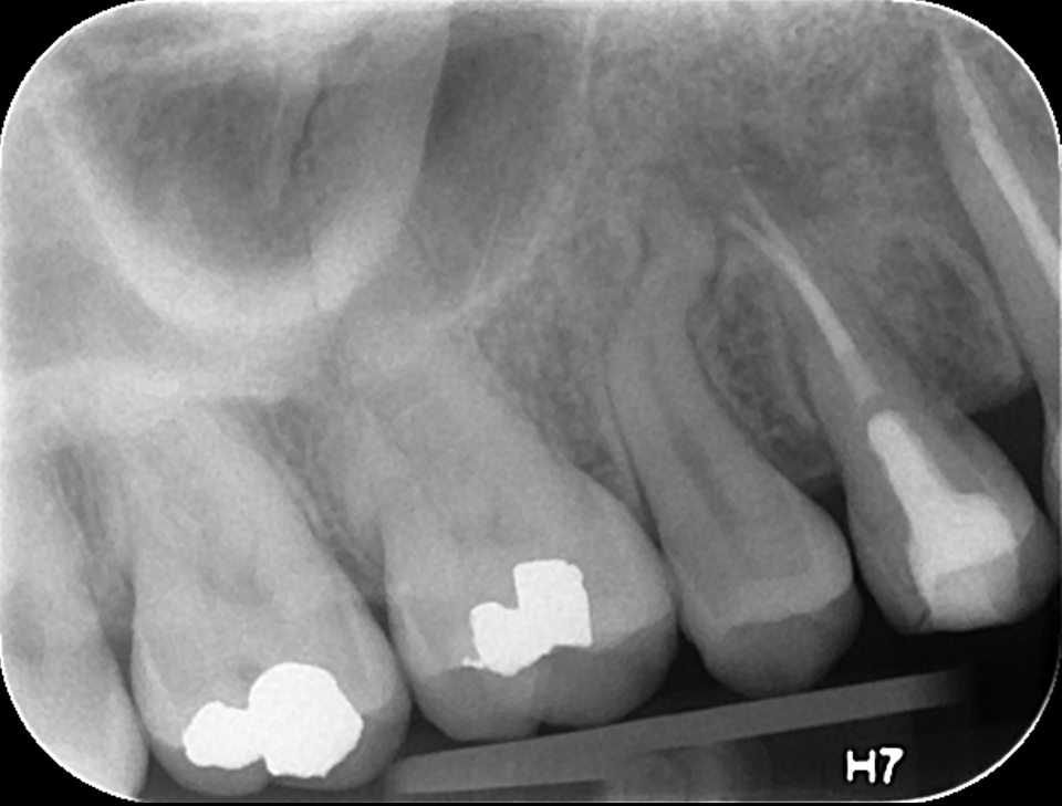Management of Dental Trauma DTR