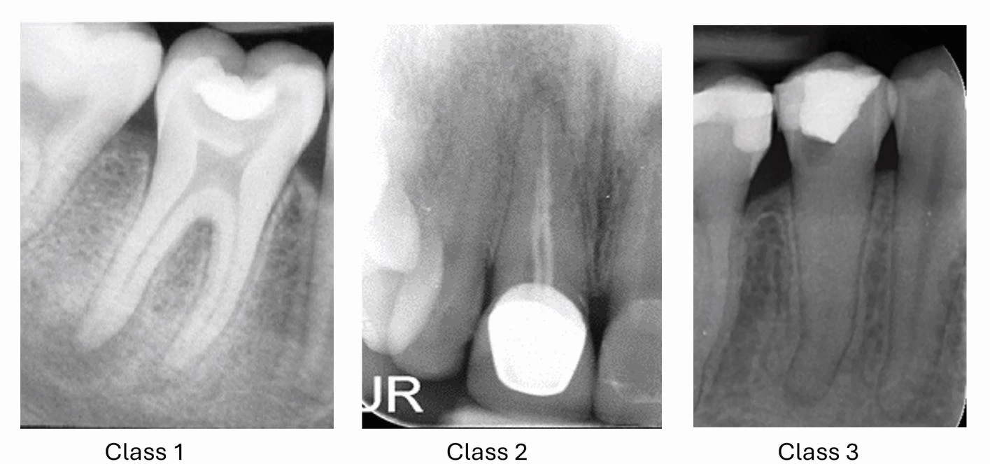 Assessing Endodontic Complexity ENDO101